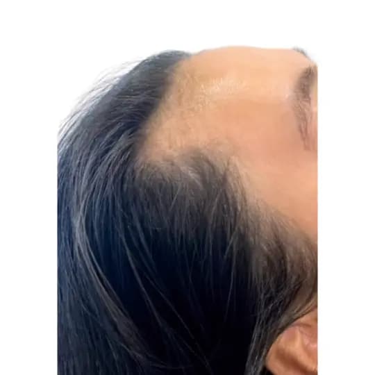 Before PRP Hair Booster