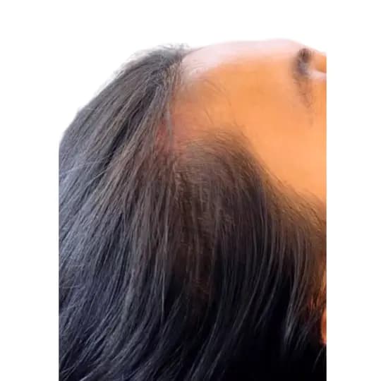 After PRP Hair Booster